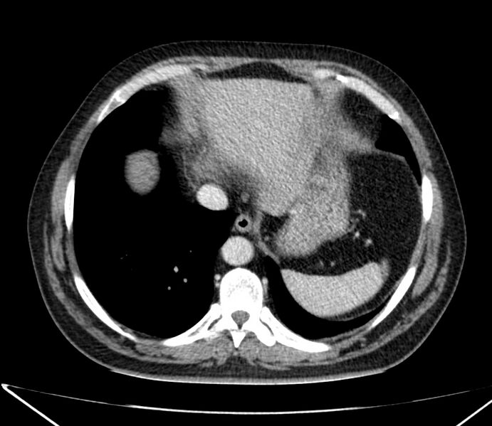 File:Carcinoid tumor with hepatic metastases (Radiopaedia 22651-22670 C 28).jpg