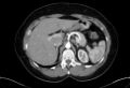 Cardiac sarcoidosis (Radiopaedia 74548-85534 A 94).jpg