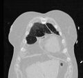 Cardiogenic pulmonary edema (Radiopaedia 29213-29609 Coronal lung window 8).jpg