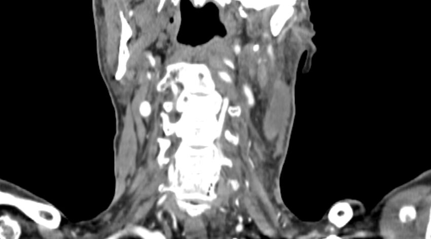 Carotid artery pseudoaneurysm (Radiopaedia 84030-99259 D 55).jpg