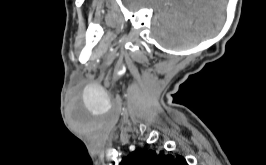 Carotid artery pseudoaneurysm (Radiopaedia 84030-99259 E 38).jpg