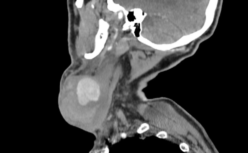 Carotid artery pseudoaneurysm (Radiopaedia 84030-99259 E 48).jpg