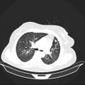Carotid body tumor (Radiopaedia 21021-20948 Axial lung window 15).jpg
