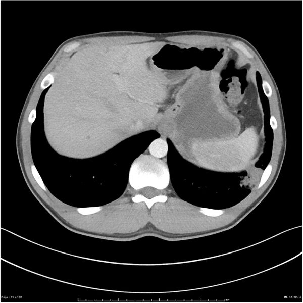 File:Cavitating lung cancer (Radiopaedia 25796-25945 C+ arterial phase 55).jpg
