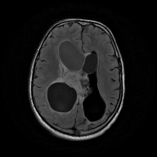 File:Central neurocytoma (Radiopaedia 67618-77021 Axial FLAIR 16).jpg