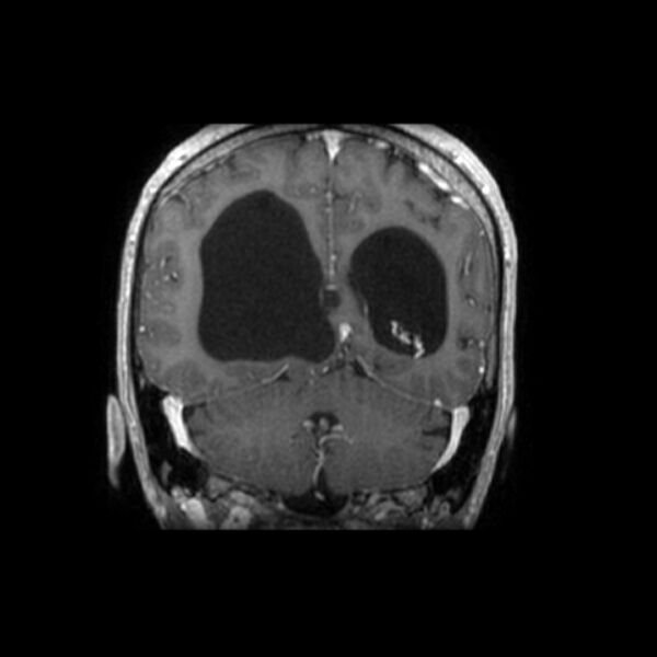 File:Central neurocytoma (Radiopaedia 67618-77021 Coronal T1 C+ 9).jpg