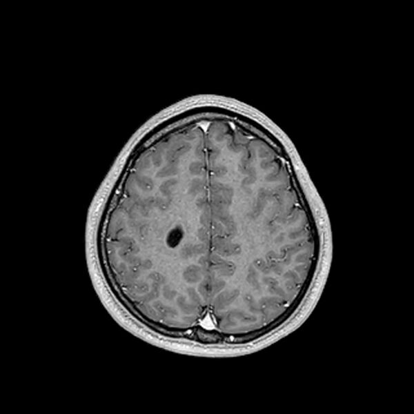 File:Central neurocytoma (Radiopaedia 79320-92380 Axial T1 C+ 182).jpg