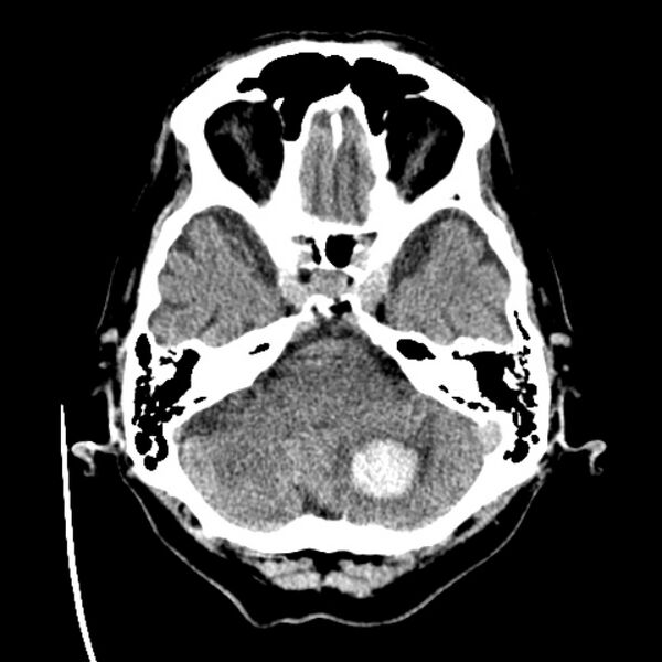 File:Cerebellar hemorrhage (Radiopaedia 27193-27359 Axial non-contrast 10).jpg