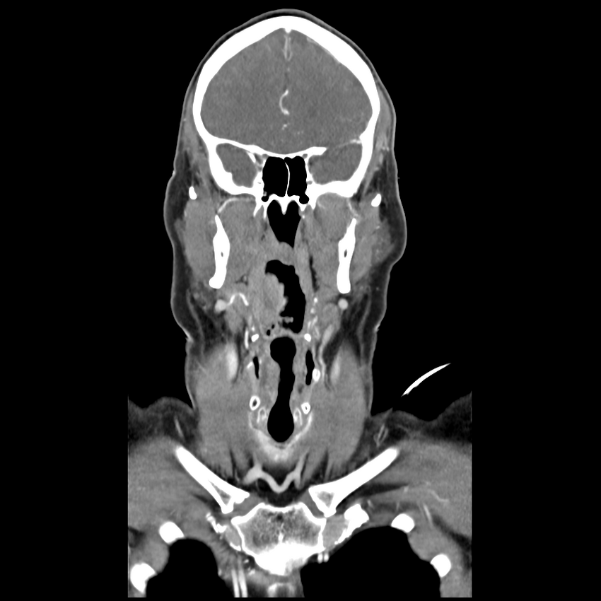 Cerebellar infarct due to vertebral artery dissection with posterior fossa decompression (Radiopaedia 82779-97029 D 21).png