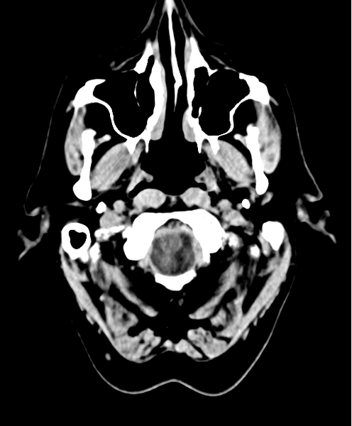 File:Cerebellar metastasis from lung adenocarcinoma (Radiopaedia 86690-102828 Axial non-contrast 2).png