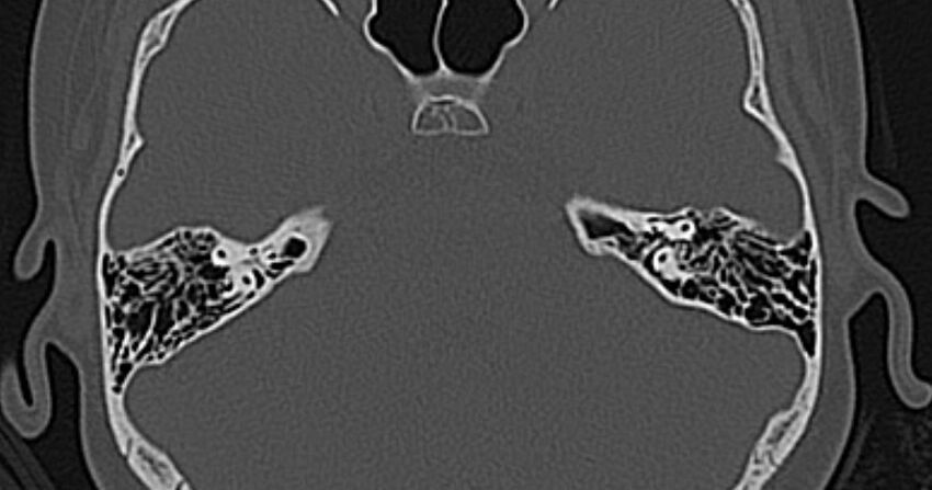 Cerebellopontine angle lipoma (Radiopaedia 57303-64242 Axial bone window 41).jpg