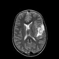 Cerebral abscess post cardiac surgery (Radiopaedia 27244-27420 Axial T2 15).jpg