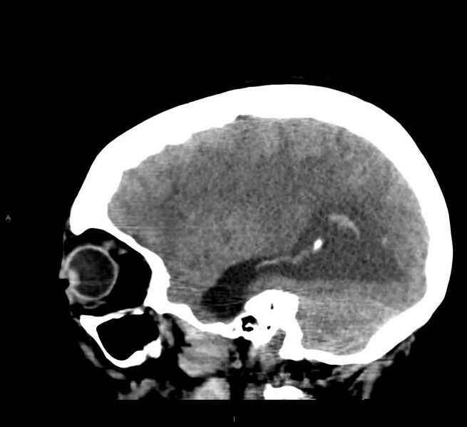 File:Cerebral amyloid angiopathy-associated lobar intracerebral hemorrhage (Radiopaedia 58379-65519 C 38).jpg