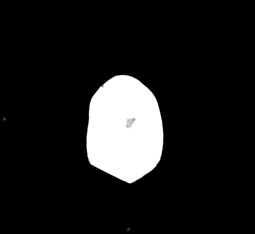 Cerebral amyloid angiopathy-associated lobar intracerebral hemorrhage (Radiopaedia 58530-65688 Axial non-contrast 4).jpg