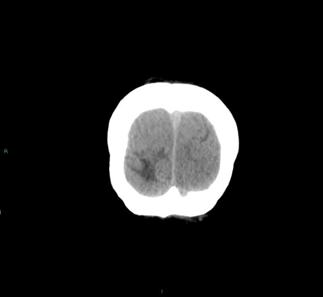 File:Cerebral amyloid angiopathy-associated lobar intracerebral hemorrhage (Radiopaedia 58561-65724 Coronal non-contrast 9).jpg