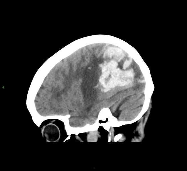 File:Cerebral amyloid angiopathy-associated lobar intracerebral hemorrhage (Radiopaedia 58563-65727 C 17).jpg