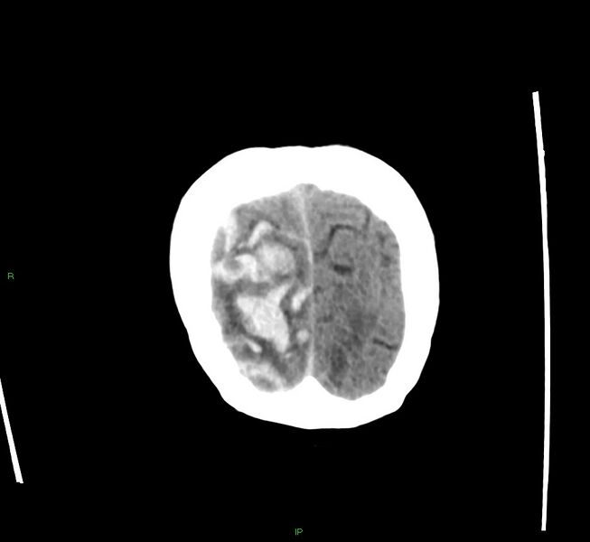 File:Cerebral amyloid angiopathy-associated lobar intracerebral hemorrhage (Radiopaedia 58563-65727 Coronal non-contrast 10).jpg