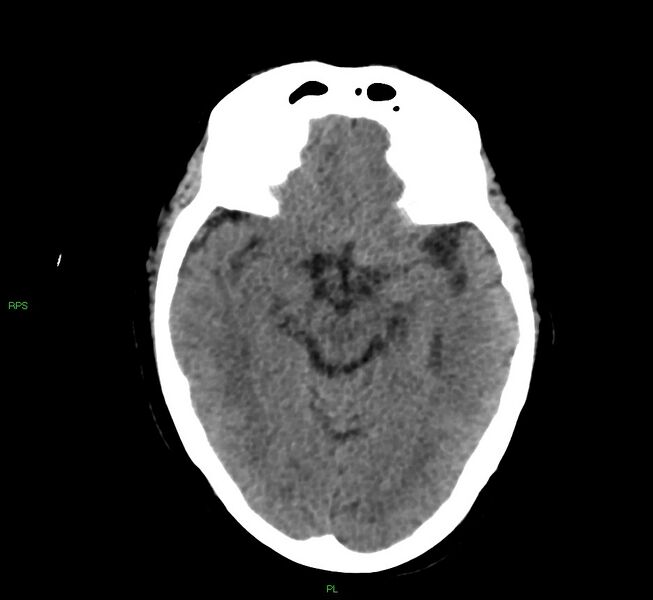 File:Cerebral amyloid angiopathy-associated lobar intracerebral hemorrhage (Radiopaedia 58569-65734 Axial non-contrast 38).jpg
