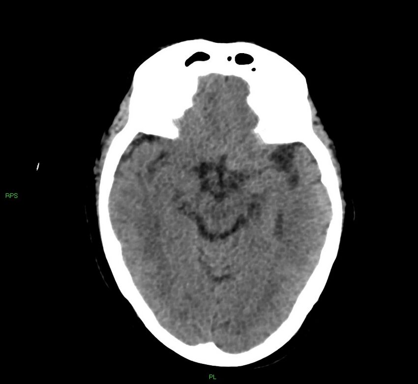 Cerebral amyloid angiopathy-associated lobar intracerebral hemorrhage (Radiopaedia 58569-65734 Axial non-contrast 38).jpg