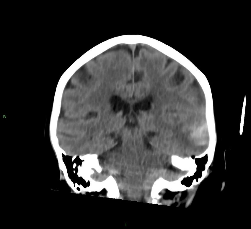 Cerebral amyloid angiopathy-associated lobar intracerebral hemorrhage (Radiopaedia 58757-65978 Coronal non-contrast 30).jpg
