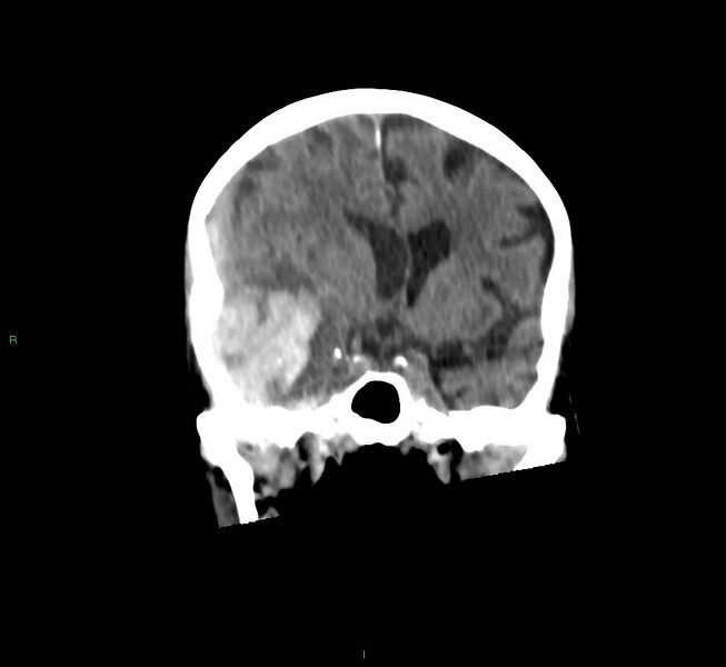 File:Cerebral amyloid angiopathy-associated lobar intracerebral hemorrhage (Radiopaedia 58758-65980 Coronal non-contrast 39).jpg