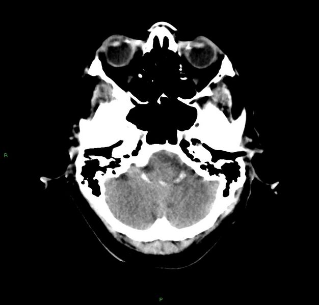 File:Cerebral amyloid angiopathy-associated lobar intracerebral hemorrhage (Radiopaedia 59356-66716 Axial non-contrast 39).jpg