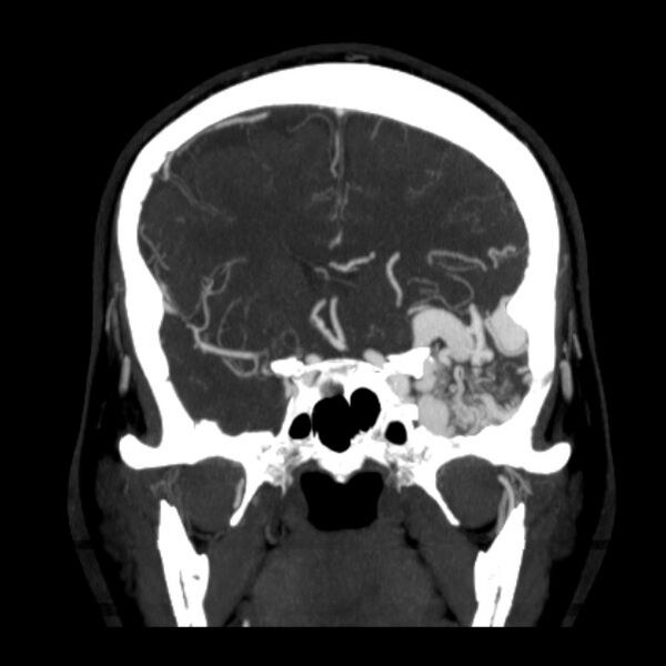File:Cerebral arteriovenous malformation (Radiopaedia 43729-47189 C 17).jpg