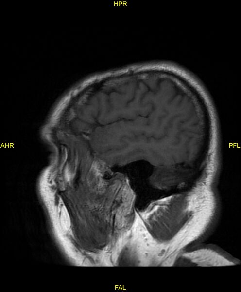 File:Cerebral autosomal dominant arteriopathy with subcortical infarcts and leukoencephalopathy (CADASIL) (Radiopaedia 86108-102054 Sagittal T1 5).jpg