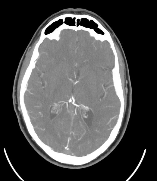 File:Cerebral dural venous sinus thrombosis (Radiopaedia 86514-102576 A 56).jpg