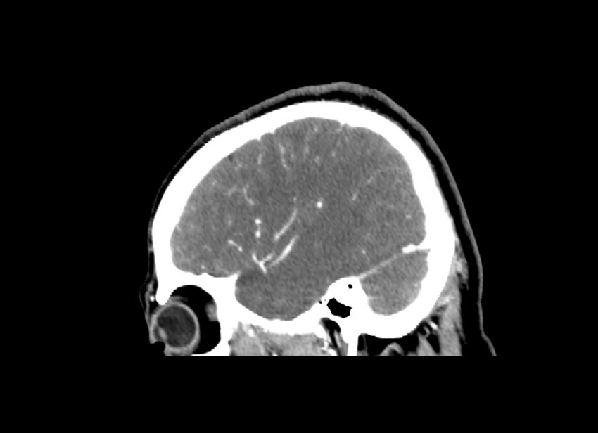 Cerebral edema (Radiopaedia 82519-96661 D 14).jpg