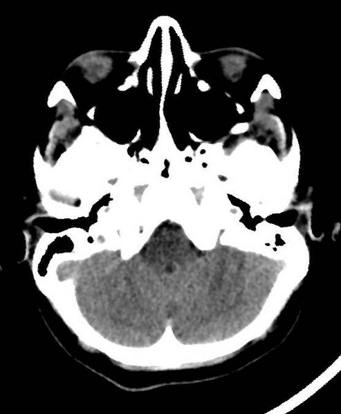 File:Cerebral edema due to severe hyponatremia (Radiopaedia 89826-106937 Axial non-contrast 16).jpg