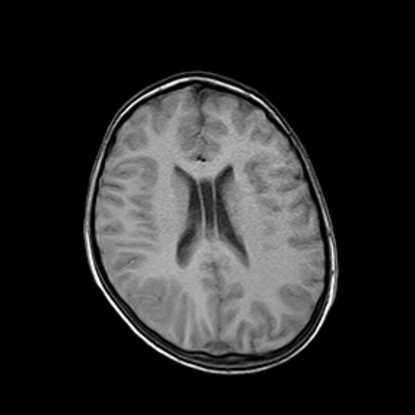 File:Cerebral tuberculoma (Radiopaedia 41152-43932 Axial T1 14).jpg