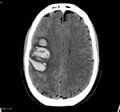 Cerebral vein thrombosis (Radiopaedia 4408-23049 Axial non-contrast 1).jpg