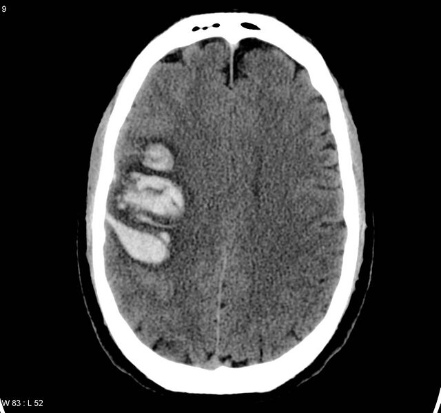 File:Cerebral vein thrombosis (Radiopaedia 4408-23049 Axial non-contrast 1).jpg