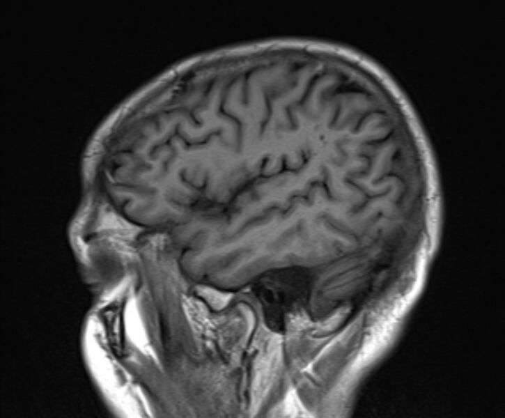 File:Cerebral venous thrombosis (Radiopaedia 71207-81504 Sagittal T1 21).jpg