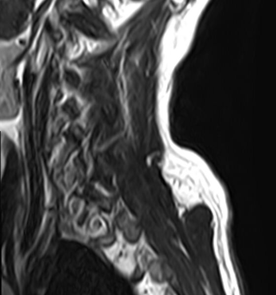 File:Cervical compressive myelopathy (Radiopaedia 71956-82411 C 2).jpg