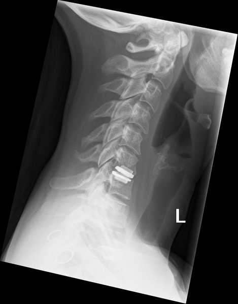 File:Cervical disc replacement (Radiopaedia 37383-39204 Lateral 1).png