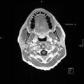 Cervical dural CSF leak on MRI and CT treated by blood patch (Radiopaedia 49748-54995 Axial T1 C+ 2).jpg