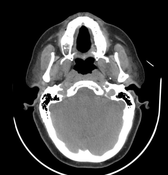 File:Cervical lymphadenopathy- cause unknown (Radiopaedia 22420-22457 non-contrast 37).jpg