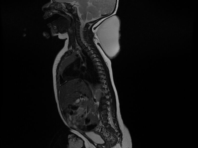 File:Cervical myelomeningocele (Radiopaedia 69569-79479 Sagittal T2 5).jpg