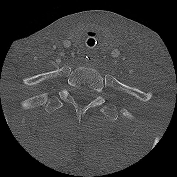File:Cervical spine fractures with vertebral artery dissection (Radiopaedia 32135-33078 Axial bone window 1).jpg