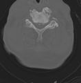 Cervical spondylolysis (Radiopaedia 49616-54811 Axial bone window 35).png