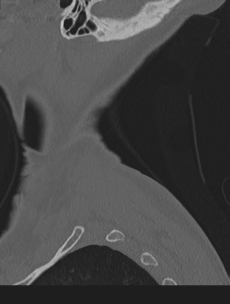 File:Cervical spondylolysis (Radiopaedia 49616-54811 Sagittal bone window 71).png