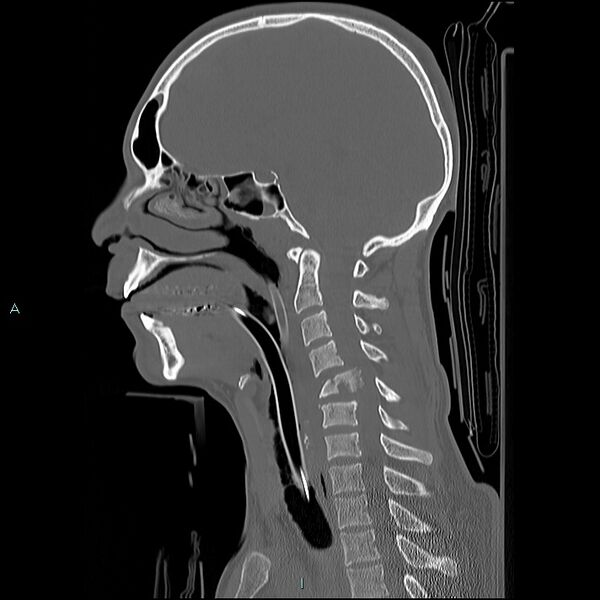 File:Cervical vertebral burst fracture (Radiopaedia 37420-39258 Sagittal bone window 15).jpg