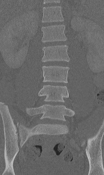 File:Chance fracture (Radiopaedia 40360-42912 Coronal bone window 29).png