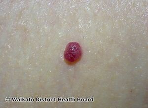 A cherry angioma on a person's arm