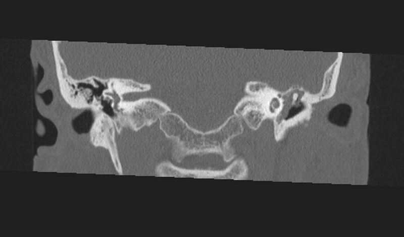 File:Cholesteatoma (Radiopaedia 10742-11203 Coronal bone window 11).jpg