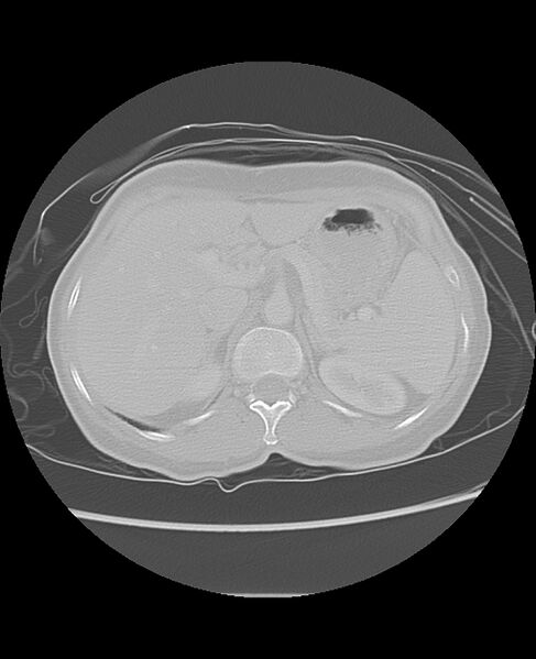 File:Chondrosarcoma (Radiopaedia 79427-92532 Axial lung window 56).jpg