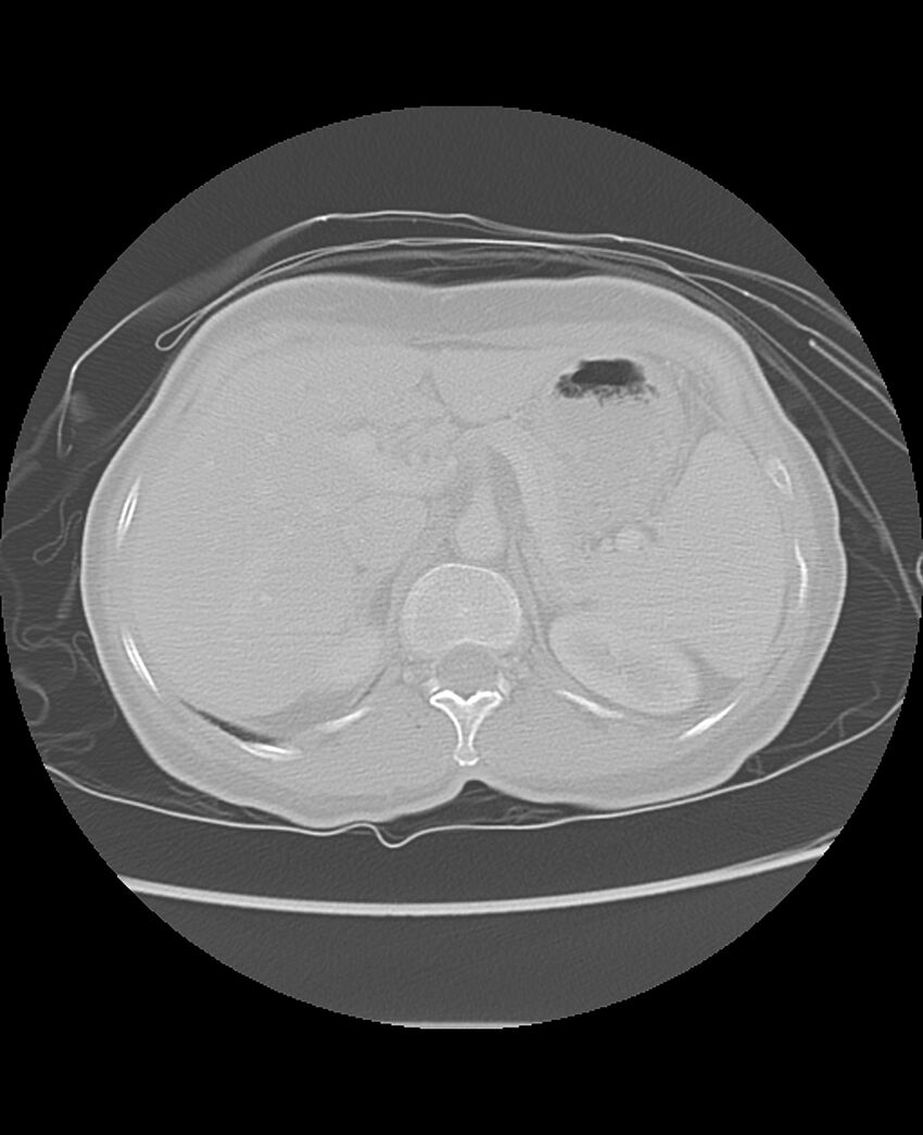 Chondrosarcoma (Radiopaedia 79427-92532 Axial lung window 56).jpg