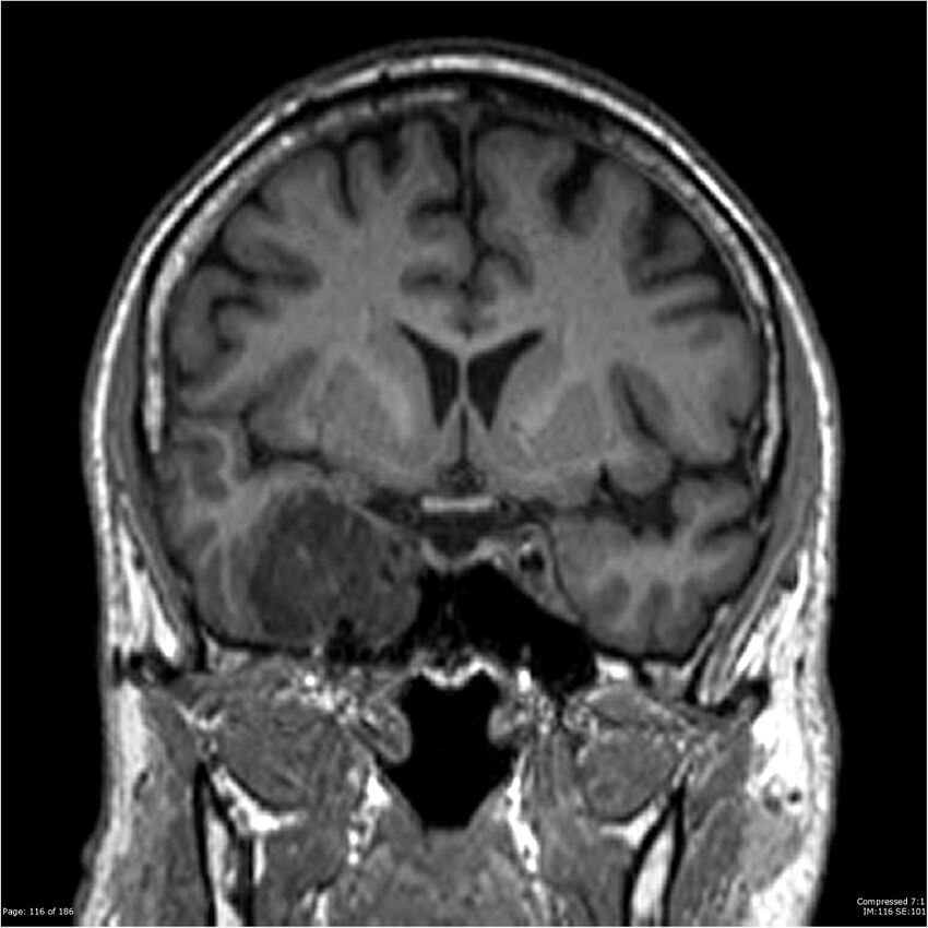 Chondrosarcoma of skull base- grade II (Radiopaedia 40948-43654 Coronal T1 37).jpg